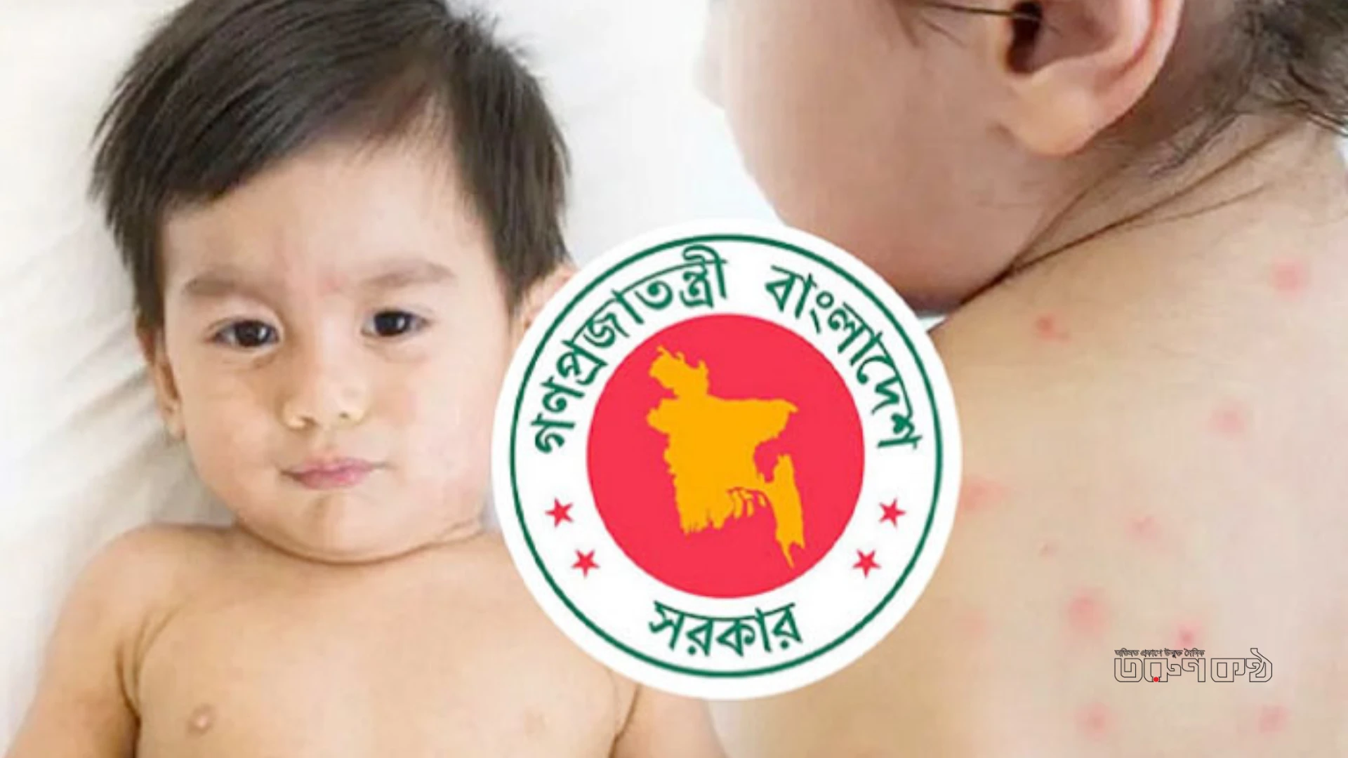 দেশে হাম ও উপসর্গে একদিনে আরও ৪ শিশুর মৃত্যু, নতুন আক্রান্ত ১০৭৭