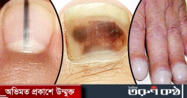 ক্যানসারের যে লক্ষণ ফুটে ওঠে নখে