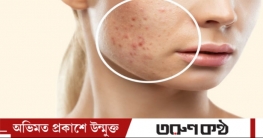 মুখের ব্রণ দূর করুন ঈদের আগেই যে চারটি কাজ করবেন
