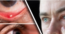 রাজশাহীতে হঠাৎ চোখ ওঠা রোগের প্রাদুর্ভাব,ফর্মেসিগুলোতে ড্রপের সং