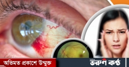 স্ট্রোকের আগে ব্যথাহীন যে লক্ষণ দেখা দেয় চোখে