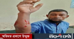 কুলাউড়ায় পাগলা কুকুরের কামড়ে নারী-পুরুষসহ ২১জন হাসপাতালে