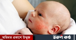 হিট র‍্যাশ থেকে দূরে রাখুন শিশুকে, অনুসরণ করুন টিপসগুলি