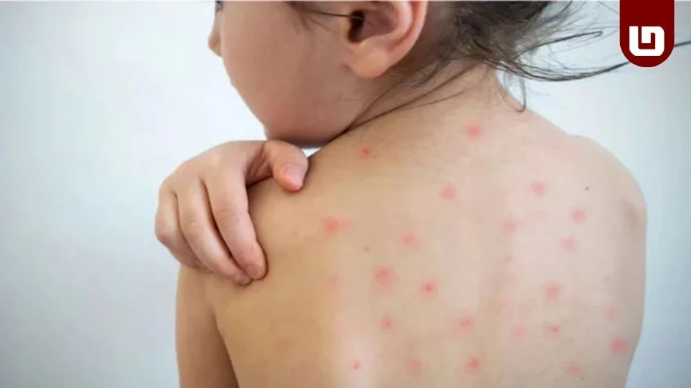 ২৪ ঘণ্টায় হামে আরও ৭ শিশুর মৃত্যু, হাসপাতালে ভর্তি ১,২৮২